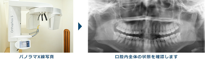 歯周病の治療について基本的な流れ