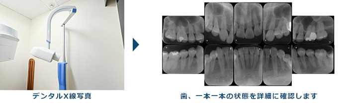歯周病の治療について基本的な流れ